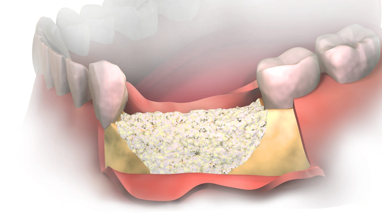 Восстановление костной ткани зубов. Костная пластика альвеолярного отростка. Костная пластика (остеопластика). Остеопластика нижней челюсти. Пластика кости при имплантации костной ткани.