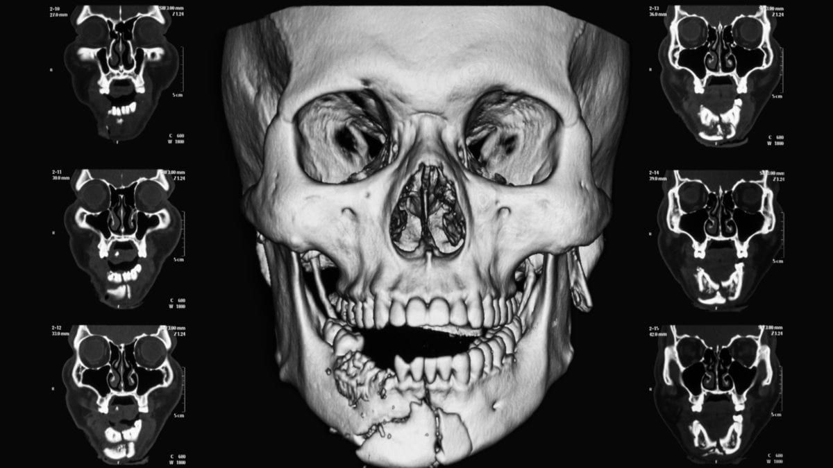X-Ray Image of Traumatized Skull