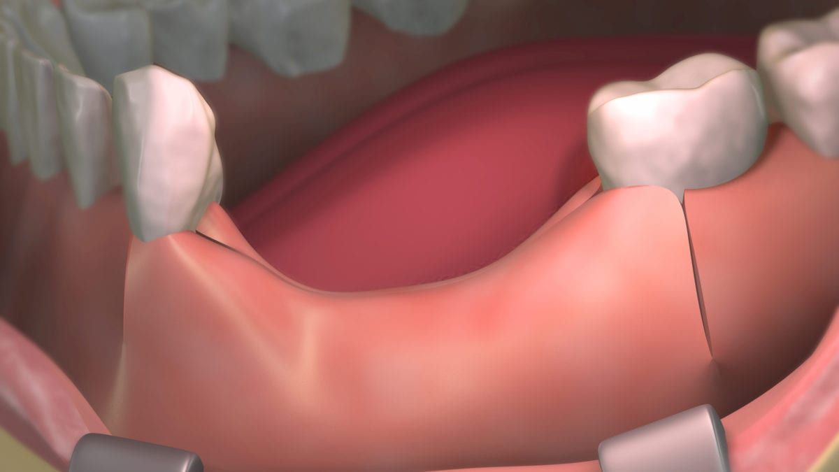 Rendering of a ridge preservation procedure result