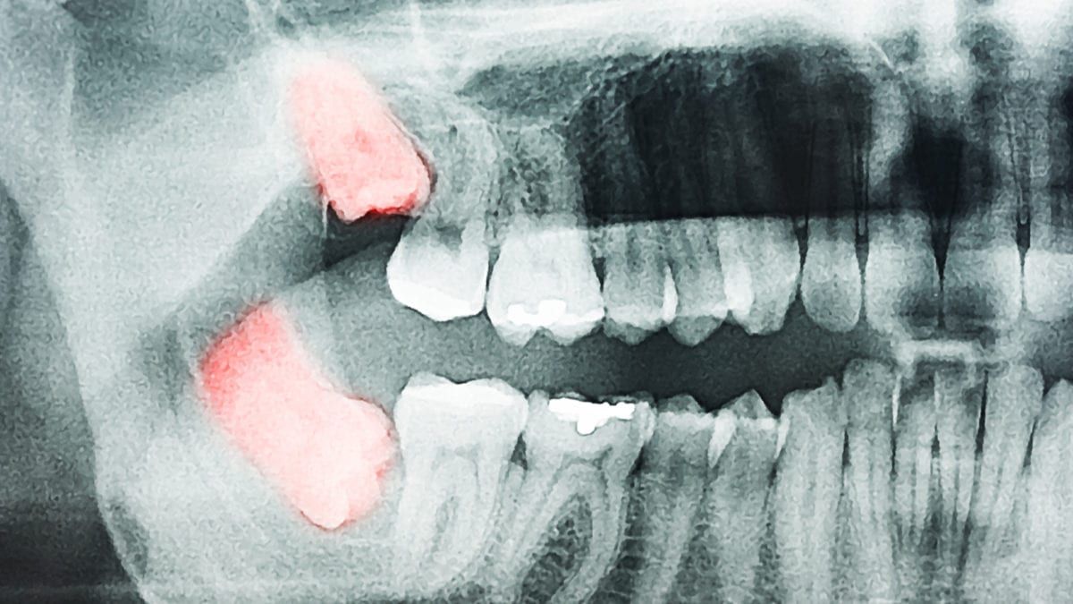 X-Ray of Impacted Wisdom Teeth